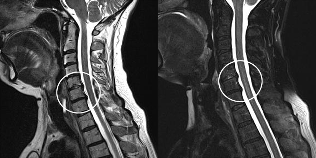 Trápaga osteokondrosia MRI irudian